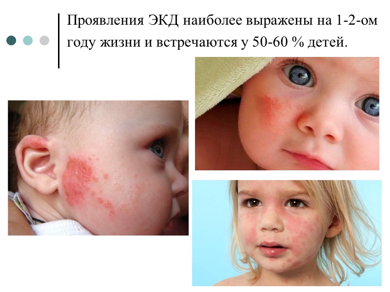 Проявления ЭКД наиболее выражены на 1-2-ом году жизни и встречаются у 50-60 % детей.